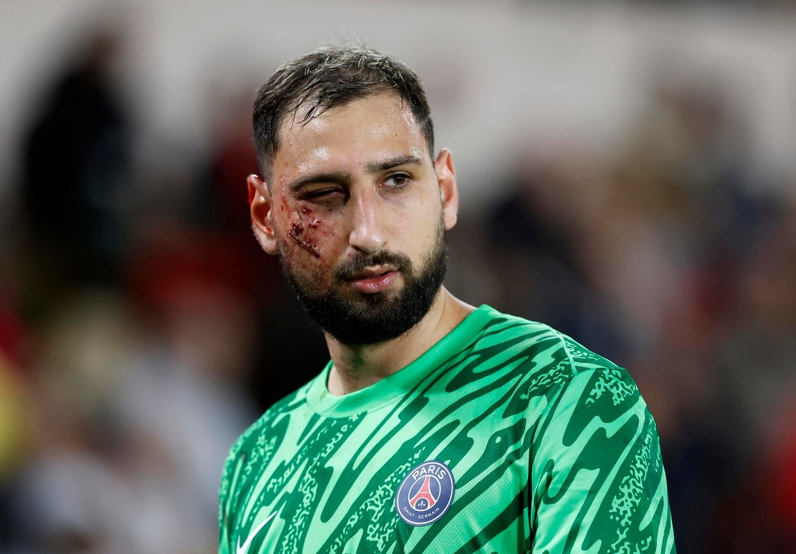 Donnarumma suffering from facial trauma awaiting further tests